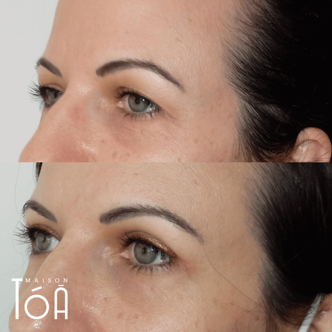 blépharoplastie