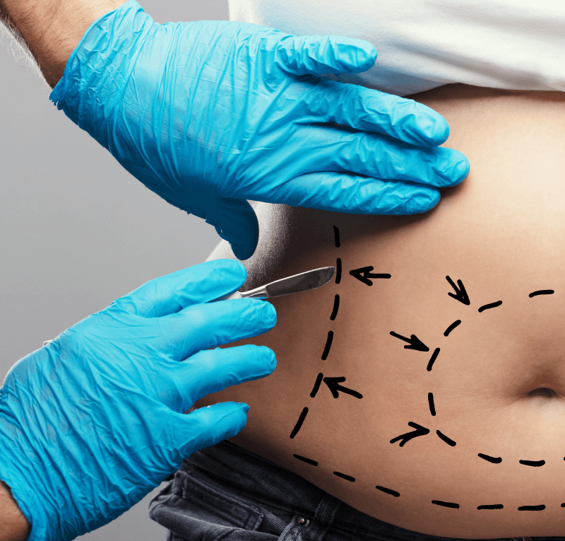 abdominaux plastie