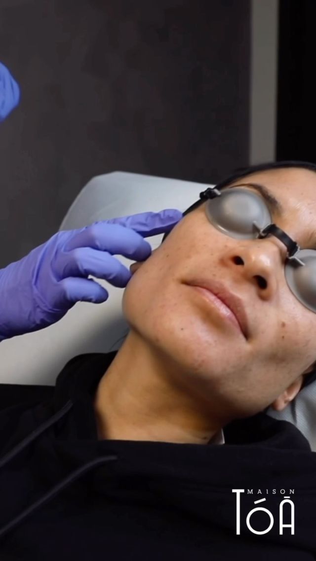 Profitez de l’hiver pour découvrir nos traitements laser à Maison Tóà.  Plus d’information sur www.maisontoa.com/laser  #laser #laserco2 #laserpigmentremoval #maisontoa