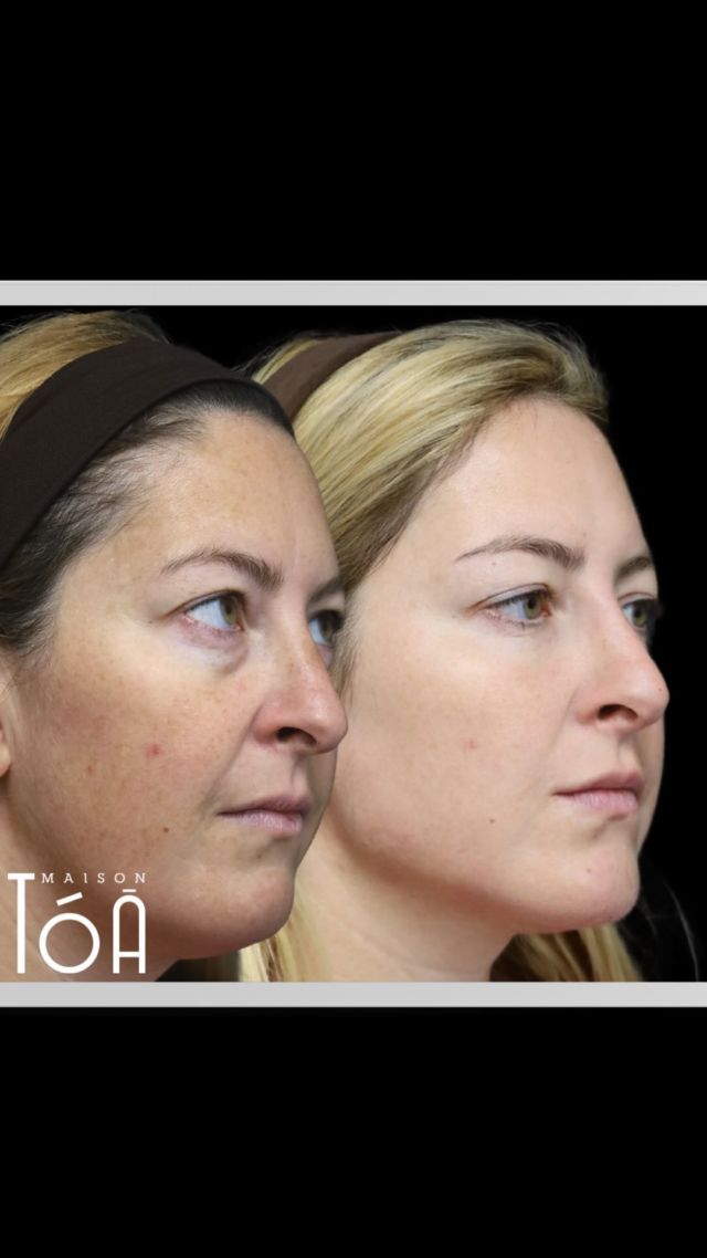 Super résultat d’un traitement full face d’acide hyaluronique. ✨  - Browlift
- Cernes 
- Jawline  Prix : 2’900.- CHF  Plus d’information sur notre site www.maisontoa.com  Prenez rendez-vous maintenant et découvrez les avantages incroyables de ce traitement! #browlift #jawline #cernes #acidehyaluronique #maisonto