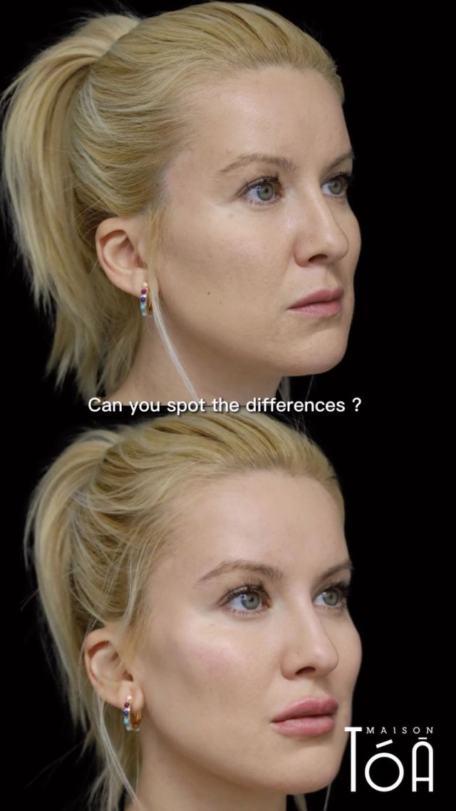 Can you spot the differences ?  Super résultat d’injections full face d’acide hyaluronique de la belle @palinakozyrava réalisé par la @dr_alexandramiles  #fullface #acidhyaluronic #acidhyaluronique #beforeafter #beforeafterfiller #fillers #filler #maisontoa