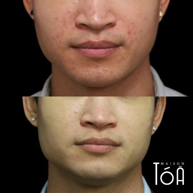 Résultats incroyables d'un traitement pour l'acné avec Microneedling médical - #Dermapen chez Maison Tóā ! 💁‍♀️ Le #Microneedling médical Dermapen consiste en de petites perforations de la peau avec des aiguilles ultrafines, stimulant ainsi la production de collagène et réduisant les imperfections de la peau.  Si vous cherchez une solution efficace pour vous débarrasser de l'acné et retrouver une peau claire et lisse, notre équipe est là pour vous aider. Nous personnalisons chaque traitement en fonction de vos besoins spécifiques et utilisons les techniques les plus avancées pour obtenir les meilleurs résultats.  Contactez-nous dès maintenant pour en savoir plus sur nos traitements pour l'acné et commencer votre voyage vers une peau plus saine et plus belle ! ✨  Plus d’information sur https://maisontoa.com/dermatologie/acne/  #maisontóā 
#dermapen
#microneedling
#acne
#acnetreatment
#skincare
#clearskin
#beauty
#skinhealth
#skincareroutine
#healthyskin
#selfcare
#aesthetic
#confidence
#skinimprovement
#beautytherapy
#glowingskin
#dermatology
#cosmetics
#skinrejuvenation